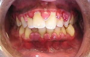 Gum disease - gingivitis - SDP Dental